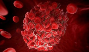 Key Biomarker Identified for Patients At Risk of Deadly Blood Clots