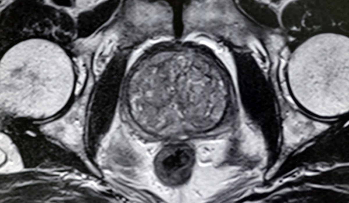 benign prostatic hyperplasia mri radiographics)