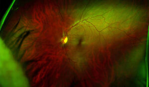 New Approach to Treating Neurodegenerative Eye Disease