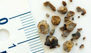 Essentials for Kidney Stone Treatment with Minimal Delay