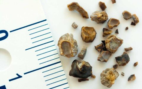 Faster Delivery of Kidney Stone Treatment Essentials