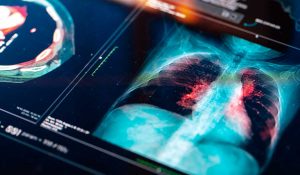 Combined Biomarker Model Tackles Indeterminate Lung Nodules