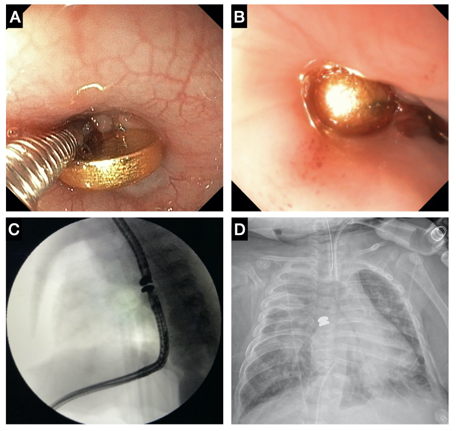 U.S. Surgeons First to Reconstruct Esophagus Using New Magnamosis Device