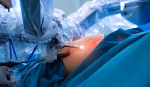 Robotic Procedure Creates Functional Ureter from Small Bowel