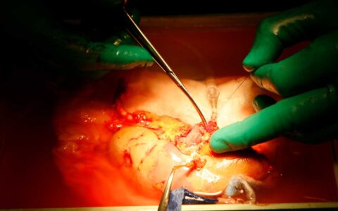 Studies Examine Viral Risks in Kidney Transplantation from HCV+ Donors