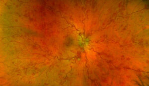 COVID-19 Linked to Retinal Vein Occlusions in Young Adults￼