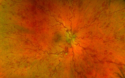 COVID-19 Linked to Retinal Vein Occlusions in Young Adults￼