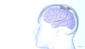 Implant Gives Hope for Idiopathic Generalized Epilepsy